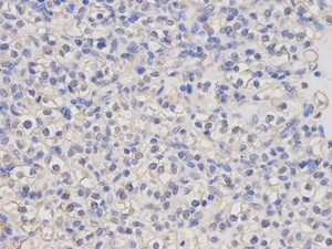 Immunohistochemical analysis of formalin-fixed and paraffin-embedded human kidney cancer tissue using LCK antibody (primary antibody dilution at 1:100)