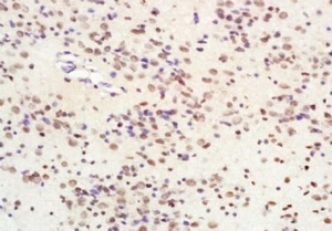 Immunohistochemical analysis of formalin-fixed paraffin embedded human glioma tissue using SIRT1 antibody (dilution at 1:200)
