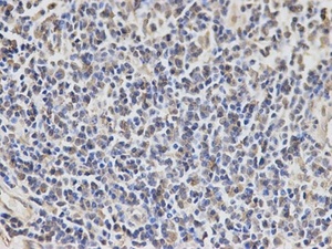 Immunohistochemical analysis of formalin-fixed and paraffin-embedded human esophageal cancer tissue using EXT1 antibody (primary antibody dilution at 1:100)
