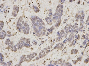 IHC-P staining of human breast cancer tissue using RAN antibody (primary antibody dilution at 1:200)