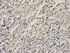 IHC-P staining of human stomach cancer tissue using GRIA3 antibody (primary antibody dilution at 1:200)