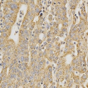 Immunohistochemical staining of paraffin embedded human stomach cancer tissue using DNMT3A antibody (primary antibody dilution at 1:200)