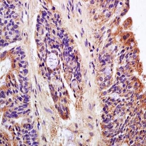 Immunohistochemical analysis of formalin-fixed paraffin embedded human colon carcinoma tissue using LAPTM4B antibody
