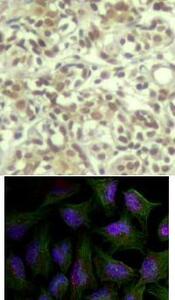 <lt/>b<gt/>Top Image:<lt/>/b<gt/> Immunohistochemical analysis of paraffin-embedded human breast carcinoma tissue using AKT1 (Phospho-Thr450).<lt/>b<gt/>Bottom Image:<lt/>/b<gt/> Immunofluorescence staining of methanol-fixed HeLa cells using AKT1 (phospho-Thr450).