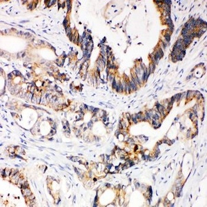 Immunohistochemical analysis of formalin-fixed paraffin embedded Human Intestinal Cancer Tissue using XIAP antibody.
