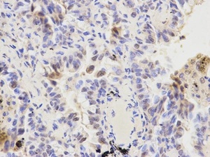 IHC-P staining of human lung cancer tissue using KPNA1 antibody (primary antibody dilution at 1:200)