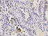 IHC-P staining of human lung cancer tissue using PRDX6 antibody (primary antibody dilution at 1:200)