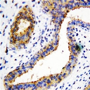 Immunohistochemical analysis of formalin-fixed paraffin embedded Human Mammary Cancer Tissue using BCAT1 antibody