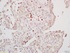 Immunohistochemical staining of human lung carcinoma tissue using Caspase 14 antibody.