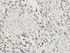 Immunohistochemical analysis of formalin-fixed and paraffin-embedded human stomach cancer tissue using TNFAIP3 antibody (primary antibody dilution at 1:200)
