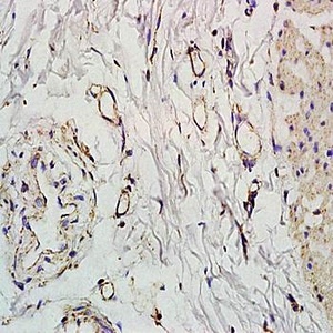 Immunohistochemical analysis of formalin-fixed and paraffin embedded human colon carcinoma tissue (dilution at:1:200) using SLC5A8 antibody