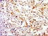 Immunohistochemical staining of human lung cancer tissue using beta Bax antibody.