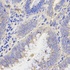 Immunohistochemical analysis of formalin-fixed and paraffin-embedded human rectal cancer tissue using RHOC antibody (primary antibody dilution at 1:200)
