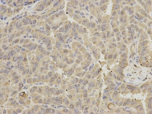 IHC-P image of human thyroid cancer tissue using GRIA3 antibody (primary antibody dilution at 1:200)