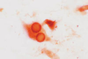 Immunohistochemical staining of synphilin-1 positive Lewy bodies in dorsal rache nucleus in a case of Parkinson’s disease using rabbit polyclonal antibody to human synphilin-1, catalogue number BSENR-116-100.