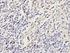 Immunohistochemical analysis of formalin-fixed and paraffin-embedded human stomach cancer tissue using PRDX6 antibody (primary antibody dilution at 1:200)