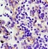 IHC-P of human melanoma tissue (CD105 antibody at 1:300)