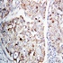 Immunohistochemical analysis of formalin-fixed paraffin embedded Human Lung Cancer Tissue using MAP2K1 antibody.