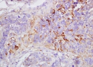 Immunohistochemical analysis of formalin-fixed paraffin embedded human lung carcinoma tissue using MMP-1 antibody (dilution at 1:200)